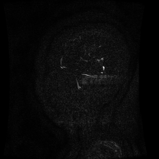 Normal noncontrast MR venography (Radiopaedia 87578-103957 A 163).jpg