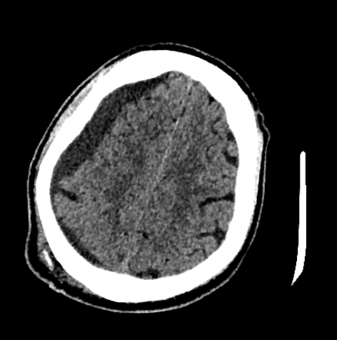 Normal pressure hydrocephalus (Radiopaedia 73685-84479 Axial non-contrast 61).jpg