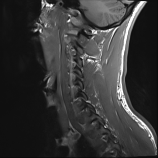 File:Normal trauma cervical spine (Radiopaedia 41017-43762 Sagittal T1 13).png