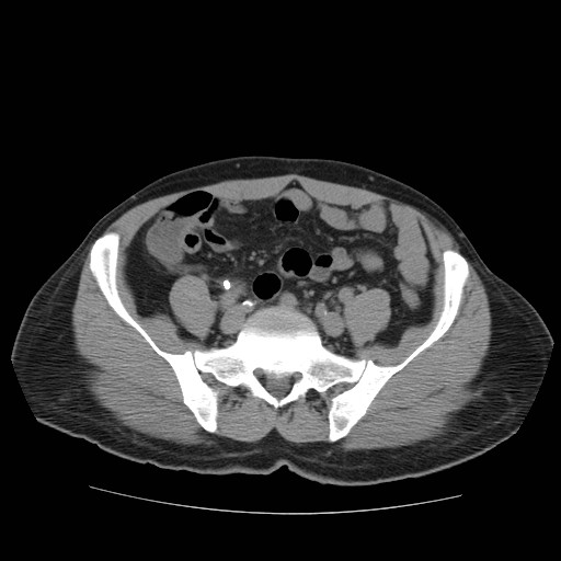 File:Obstructed kidney with perinephric urinoma (Radiopaedia 26889-27067 Axial non-contrast 32).jpg