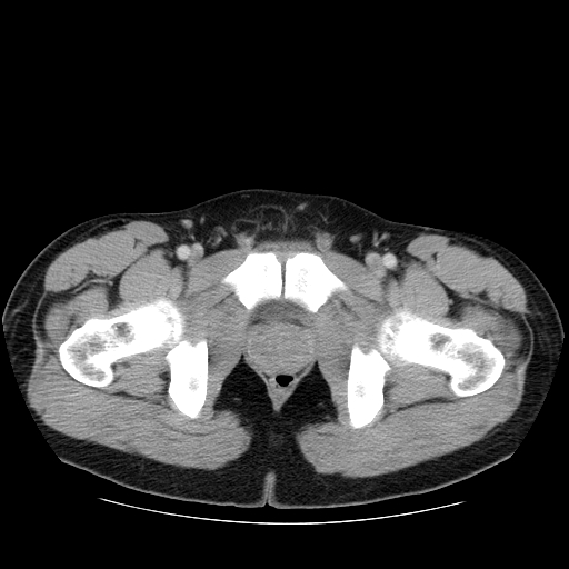 File:Obstructing ureteric calculus (Radiopaedia 18615-18514 B 57).jpg