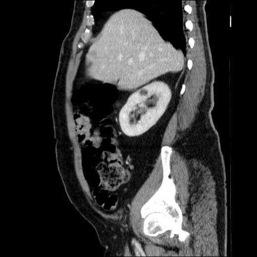 Obstructing ureteric calculus (Radiopaedia 49281-54373 C 65).jpg