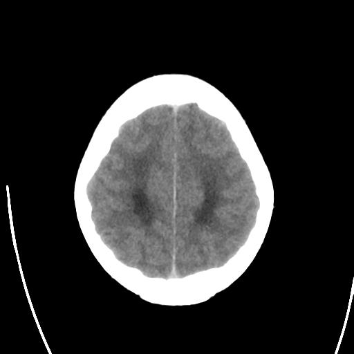 File:Obstructive hydrocephalus (Radiopaedia 30453-31119 Axial non-contrast 23).jpg