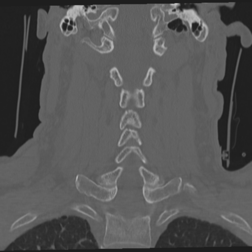 File:Occipital condyle fracture (Radiopaedia 33467-34517 Coronal bone window 39).png