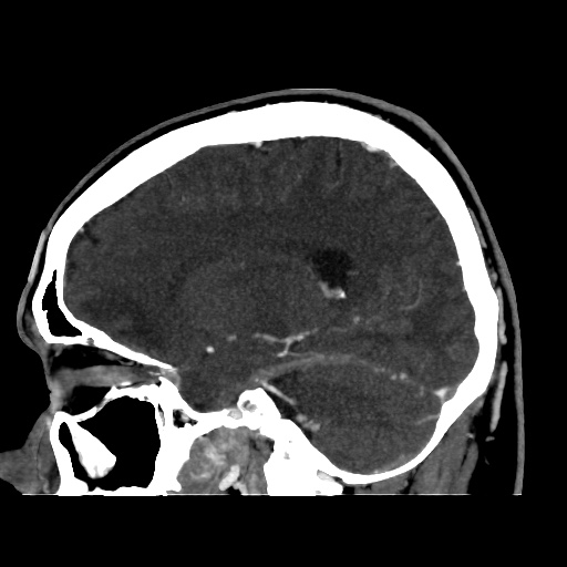 Occipital extradural hematoma simulating venous sinus thrombosis (Radiopaedia 46514-50964 D 30).jpg