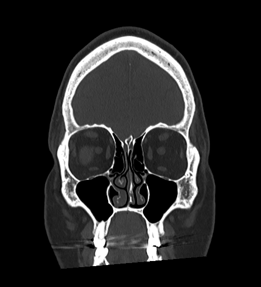 Occipital spur and Currarino type A atlas anomaly (Radiopaedia 87027-103285 Coronal bone window 42).jpg