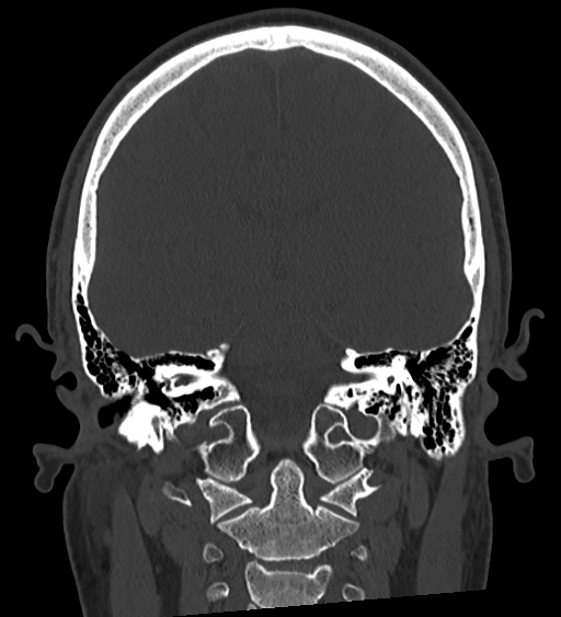Occipital spur and Currarino type A atlas anomaly (Radiopaedia 87027-103285 Coronal bone window 90).jpg