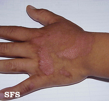 File:Phytophotodermatitis (Dermatology Atlas 6).jpg