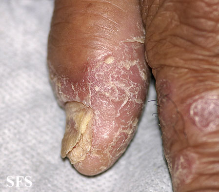 File:Psoriasis (Dermatology Atlas 38).jpg