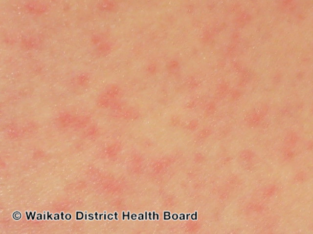 File:Zika virus infection (DermNet NZ viral-zika-5).jpg