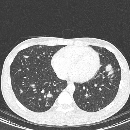 AIDS-related Kaposi sarcoma (Radiopaedia 85247-100811 Axial lung window 121).jpg