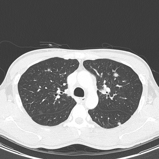 File:AIDS-related Kaposi sarcoma (Radiopaedia 85247-100811 Axial lung window 53).jpg