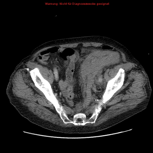 Abdominal aortic aneurysm- extremely large, ruptured (Radiopaedia 19882-19921 Axial C+ arterial phase 65).jpg