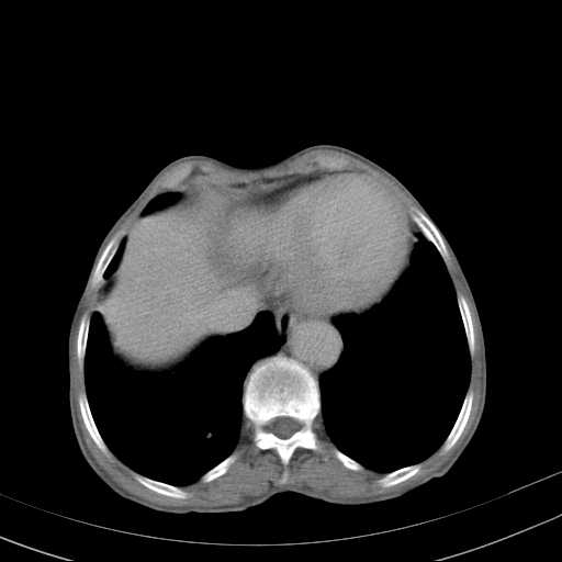 File:Abdominal aortic aneurysm (Radiopaedia 20827-20742 Axial C+ delayed 1).jpg