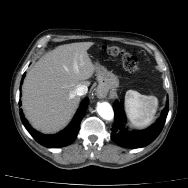 Abdominal aortic aneurysm (Radiopaedia 29248-29660 Axial C+ arterial phase 13).jpg