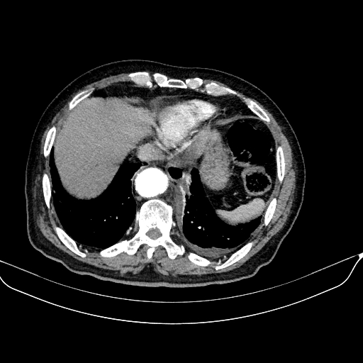 File:Abdominal aortic aneurysm (Radiopaedia 67117-76452 Axial C+ arterial phase 17).jpg