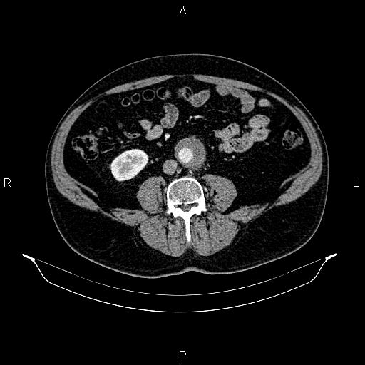 Abdominal aortic aneurysm (Radiopaedia 83094-97462 Axial renal cortical phase 112).jpg