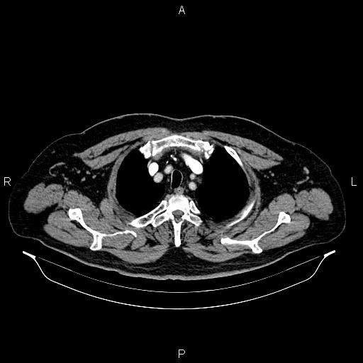 File:Abdominal aortic aneurysm (Radiopaedia 83094-97462 Axial renal cortical phase 13).jpg
