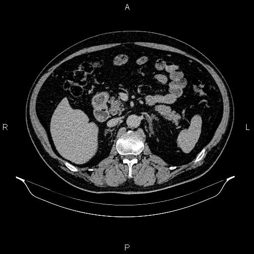 Abdominal aortic aneurysm (Radiopaedia 83094-97462 Axial renal excretory phase 40).jpg