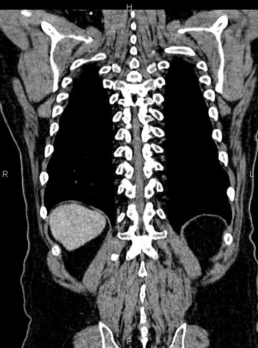 Abdominal aortic aneurysm (Radiopaedia 83094-97462 Coronal renal cortical phase 76).jpg