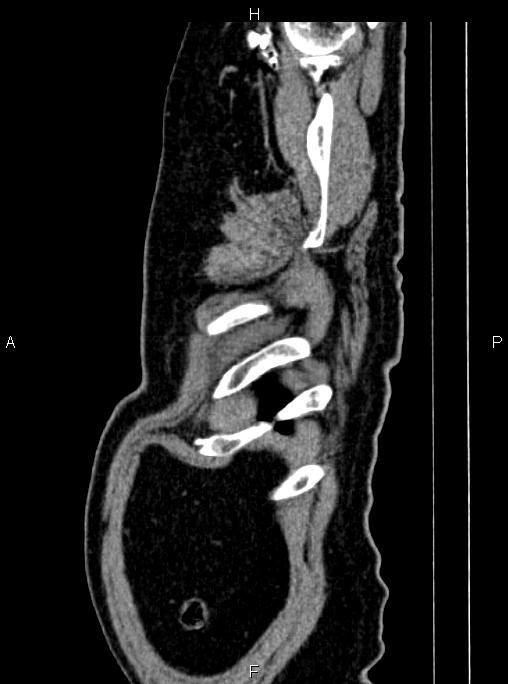 Abdominal aortic aneurysm (Radiopaedia 83094-97462 Sagittal renal cortical phase 12).jpg