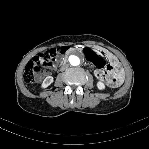 Abdominal aortic aneurysm (Radiopaedia 83581-98689 Axial C+ arterial phase 64).jpg