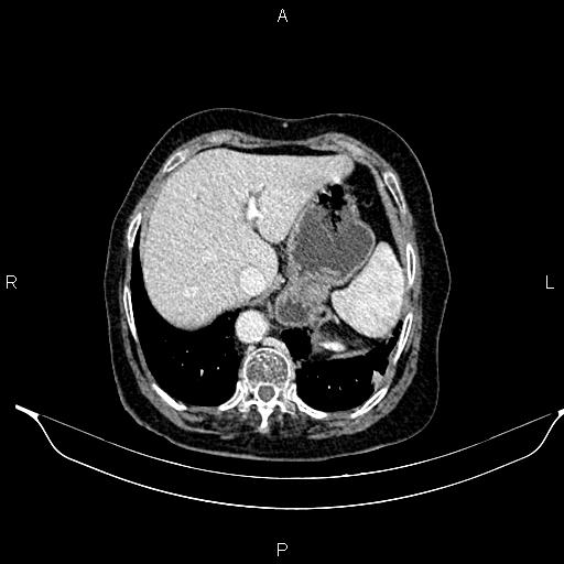 File:Abdominal aortic aneurysm (Radiopaedia 85063-100606 Axial C+ portal venous phase 29).jpg