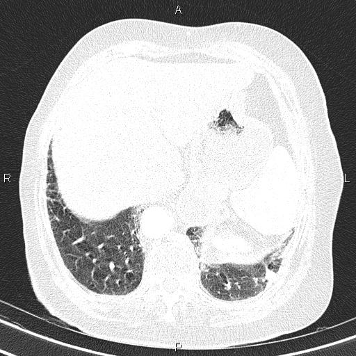 Abdominal aortic aneurysm (Radiopaedia 85063-100606 Axial lung window 56).jpg