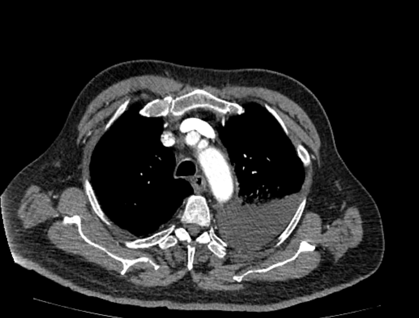 Abdominal aortic aneurysm rupture (Radiopaedia 54179-60362 Axial C+ arterial phase 4).jpg