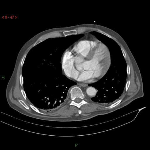File:Abdominal aortic aneurysm rupture with aortocaval fistula (Radiopaedia 14897-14841 Axial C+ arterial phase 47).jpg