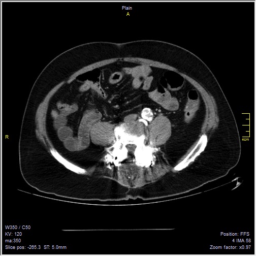 Abdominal aortic aneurysm with thrombus fissuration (Radiopaedia 47340-51926 Axial C+ arterial phase 42).jpg