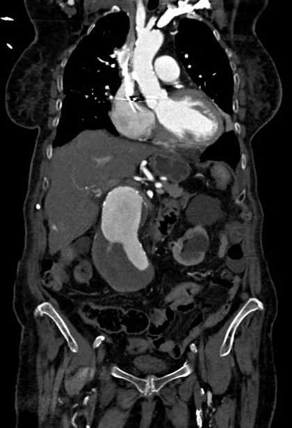 Abdominal aortic aneurysm with thrombus fissuration (Radiopaedia 73192-83919 Coronal C+ arterial phase 28).jpg