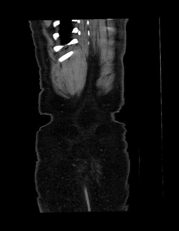 Abdominal lymphoma - with sandwich sign (Radiopaedia 53486-59492 C+ portal venous phase 1).jpg