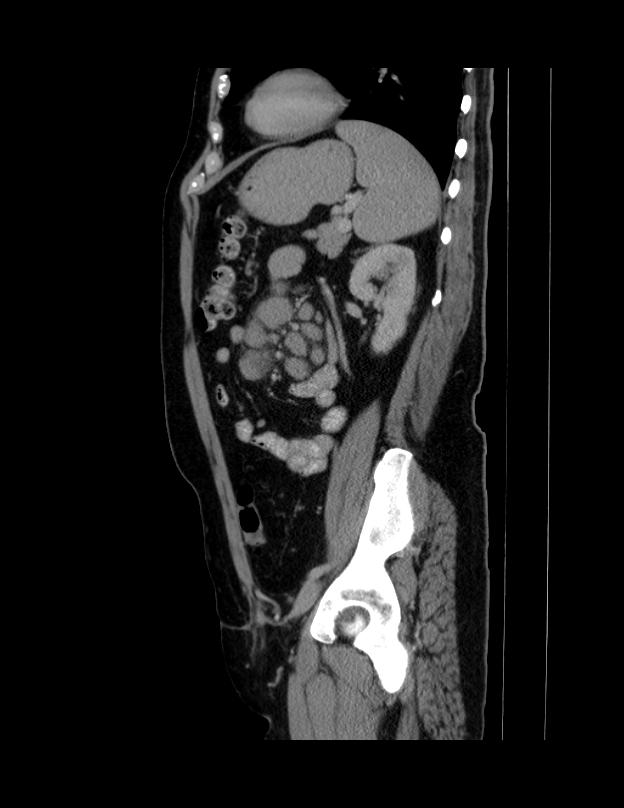 Abdominal lymphoma - with sandwich sign (Radiopaedia 53486-59492 Sagittal C+ portal venous phase 23).jpg
