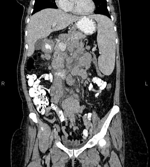 Abdominal lymphoma with sandwich sign (Radiopaedia 84378-99704 Coronal C+ portal venous phase 23).jpg
