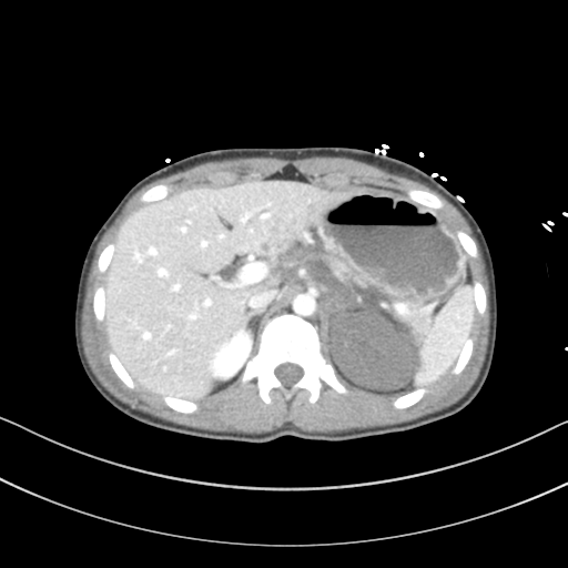 Abdominal multi-trauma - devascularised kidney and liver, spleen and pancreatic lacerations (Radiopaedia 34984-36486 Axial C+ portal venous phase 21).png