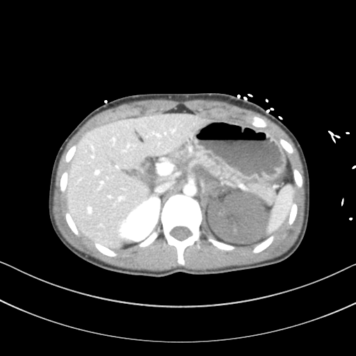Abdominal multi-trauma - devascularised kidney and liver, spleen and pancreatic lacerations (Radiopaedia 34984-36486 Axial C+ portal venous phase 23).png