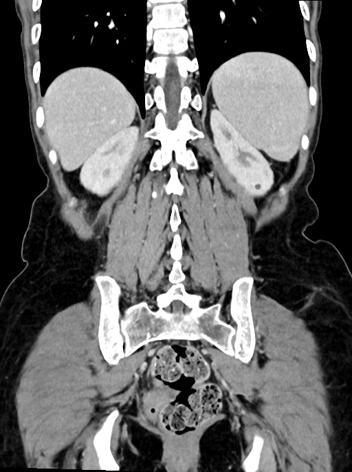 Abdominal wall and retroperitoneal tuberculosis (Radiopaedia 88137-104729 Coronal C+ portal venous phase 78).jpg