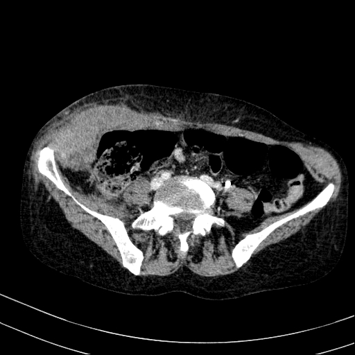 Abdominal wall hematoma with active bleeding (Radiopaedia 83915-99117 Axial C+ portal venous phase 83).jpg
