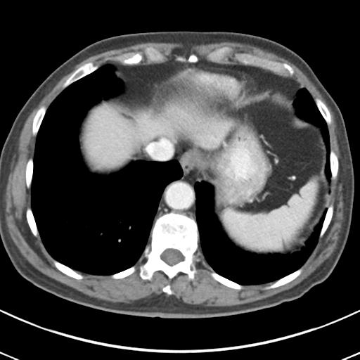 File:Abdominal wall metastasis from colorectal carcinoma (Radiopaedia 31016-31717 Axial C+ portal venous phase 12).jpg