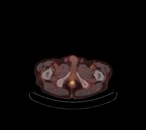 Abdominal wall metastasis from colorectal carcinoma (Radiopaedia 31016-31719 C 16).jpg