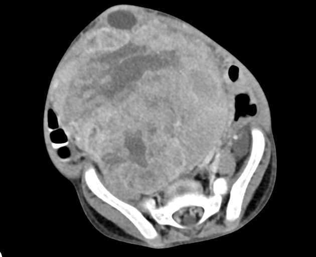 Abdominopelvic rhabdomyosarcoma (Radiopaedia 78356-90984 Axial C+ portal venous phase 122).jpg