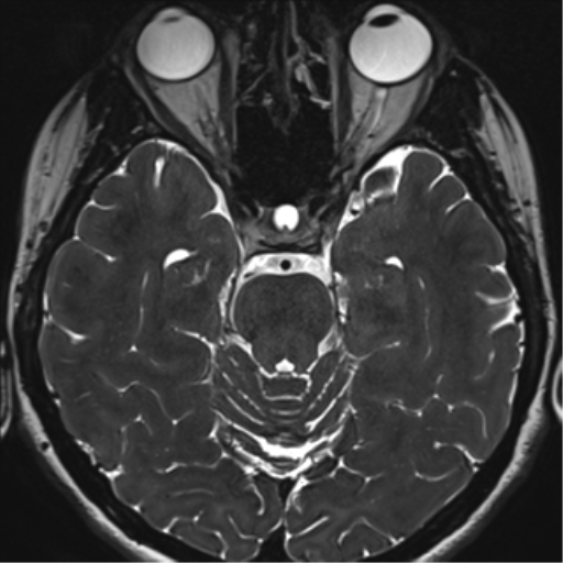 File:Abducens nerve palsy (Radiopaedia 51069-56648 Axial T2 fat sat 53).png