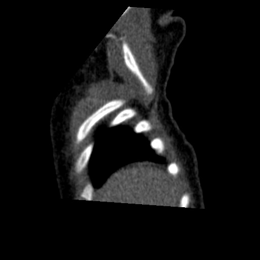 Aberrant left pulmonary artery (pulmonary sling) (Radiopaedia 42323-45435 Sagittal C+ arterial phase 3).jpg
