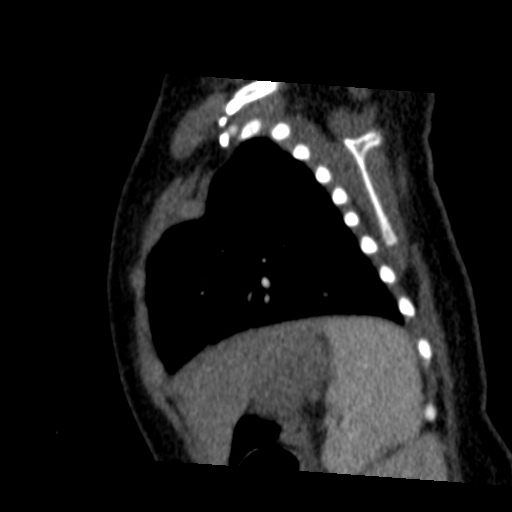 File:Aberrant left pulmonary artery (pulmonary sling) (Radiopaedia 42323-45435 Sagittal C+ arterial phase 45).jpg