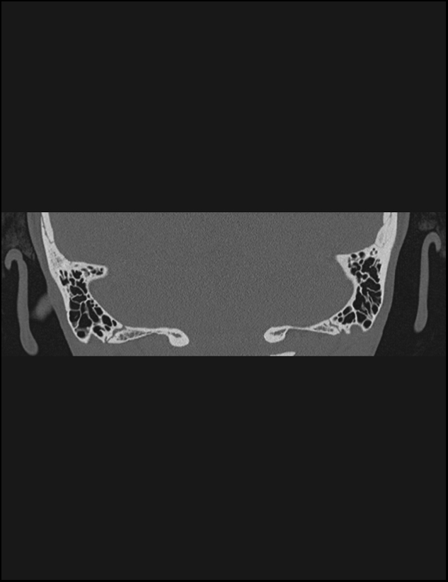 Aberrant right internal carotid artery (Radiopaedia 65191-74198 Coronal non-contrast 71).jpg