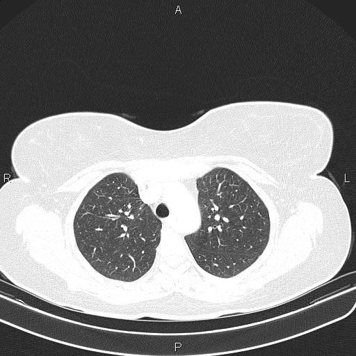 File:Aberrant right subclavian artery (Radiopaedia 87334-103629 Axial lung window 22).jpg