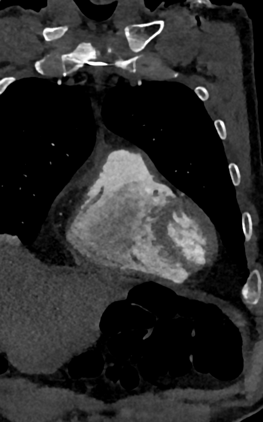 Accessory left atrial appendage (Radiopaedia 81987-95968 Coronal C+ arterial phase 12).jpg