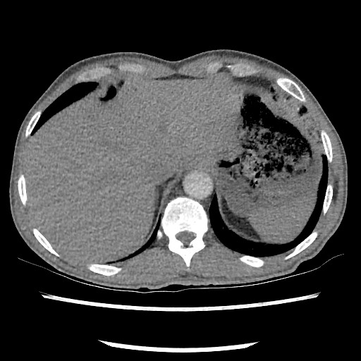 Accessory left horizontal fissure with lingular pneumonia (Radiopaedia 53763-59843 Axial C+ CTPA 80).jpg