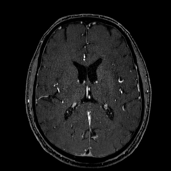 Accessory middle cerebral artery (Radiopaedia 73114-83828 Axial MRA 120).jpg